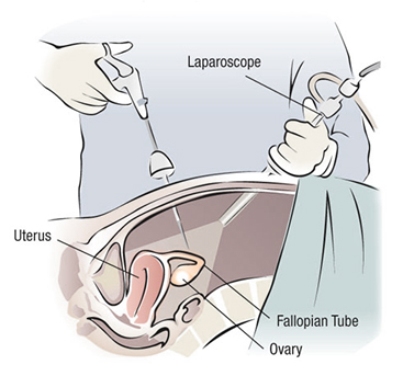 fertility-surgery
